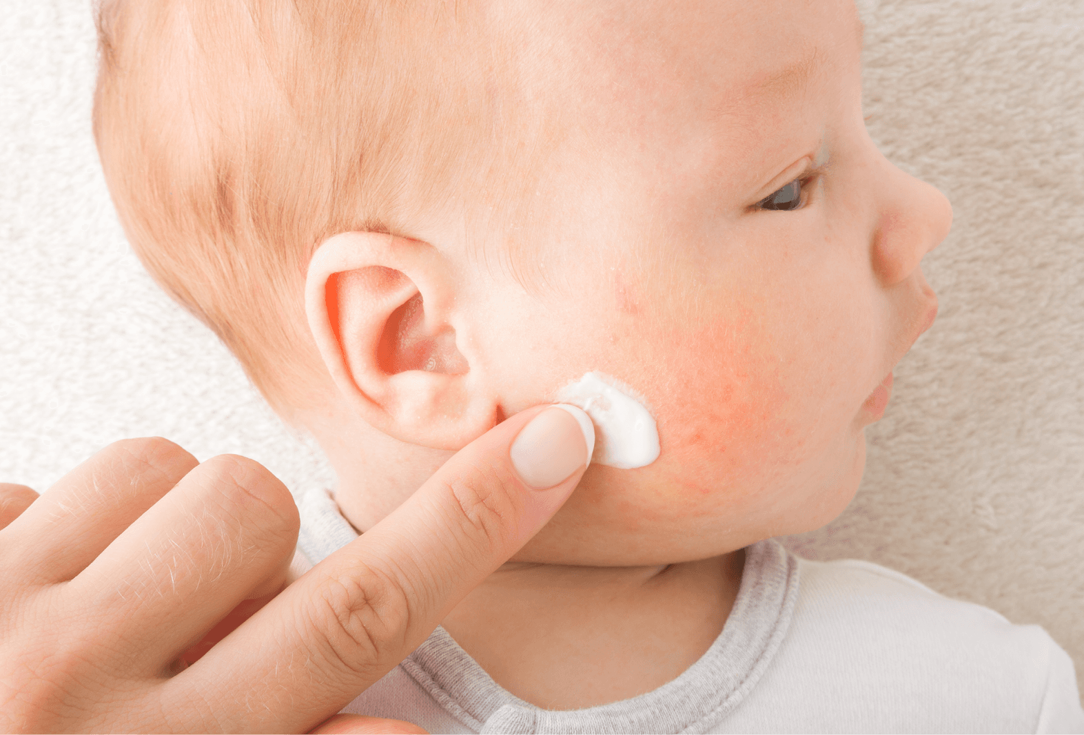 baby getting cream put on sore face