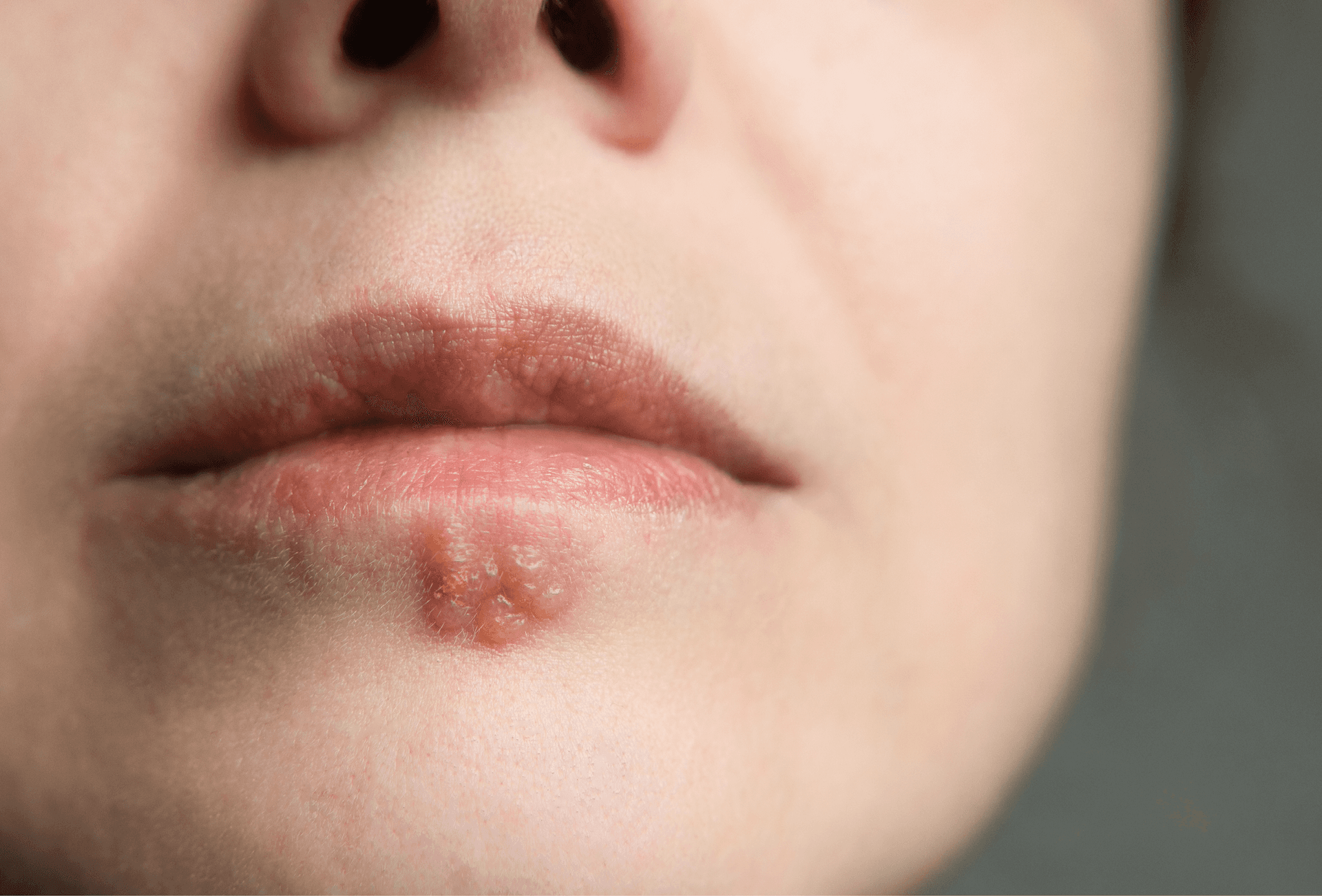 person with cold sores on lower lip