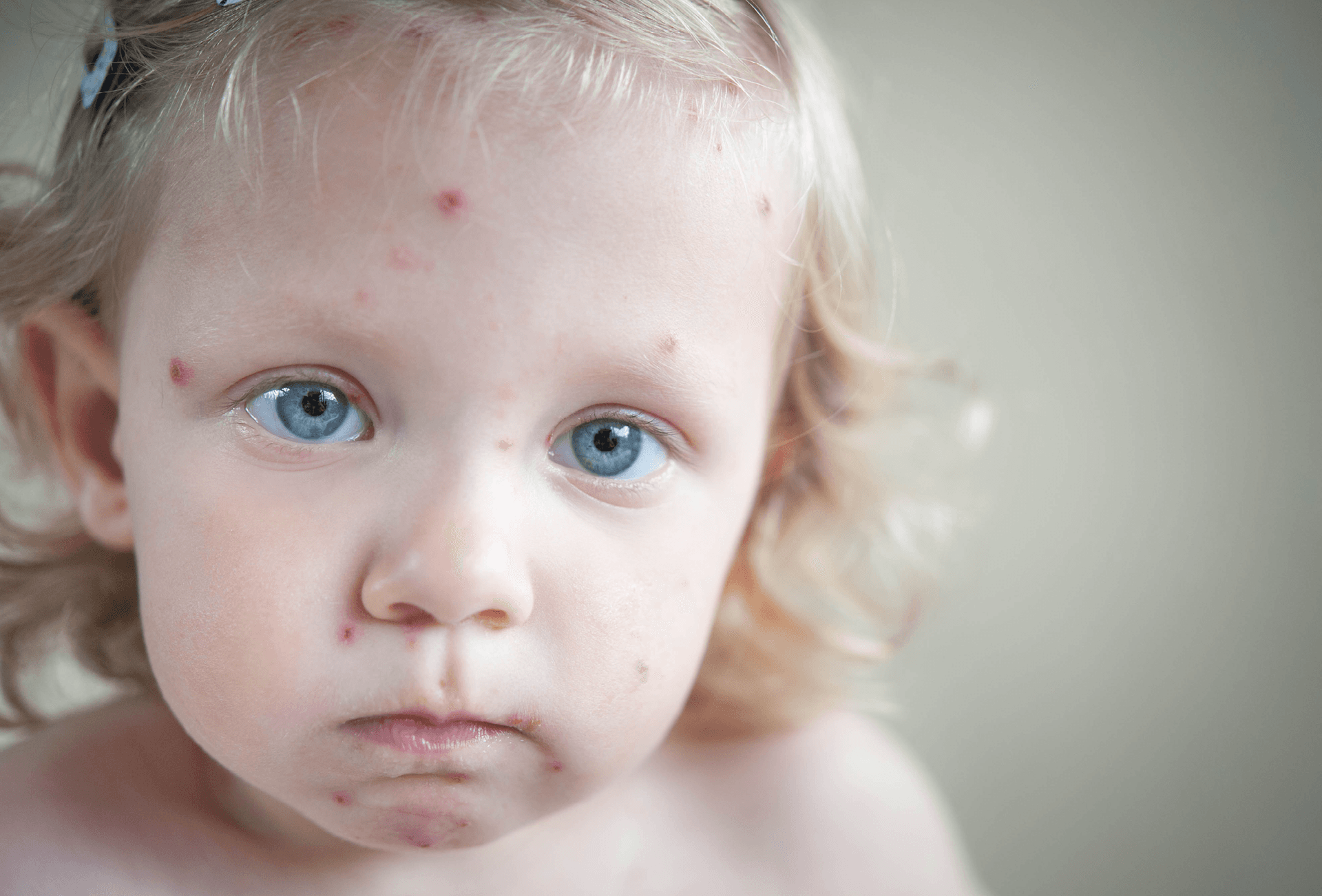 child covered in chickenpox