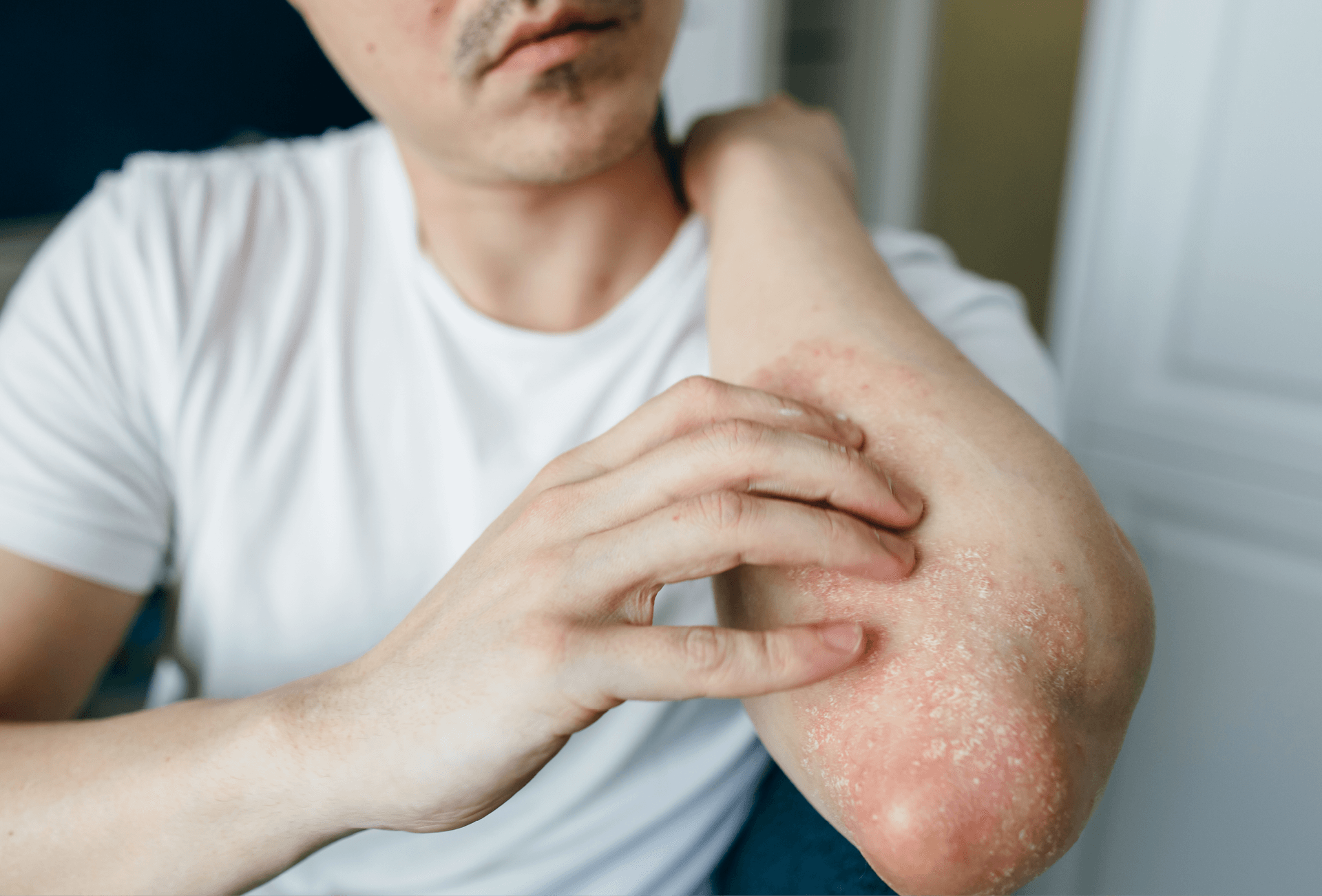 man looking at and touching his arm which has eczema 