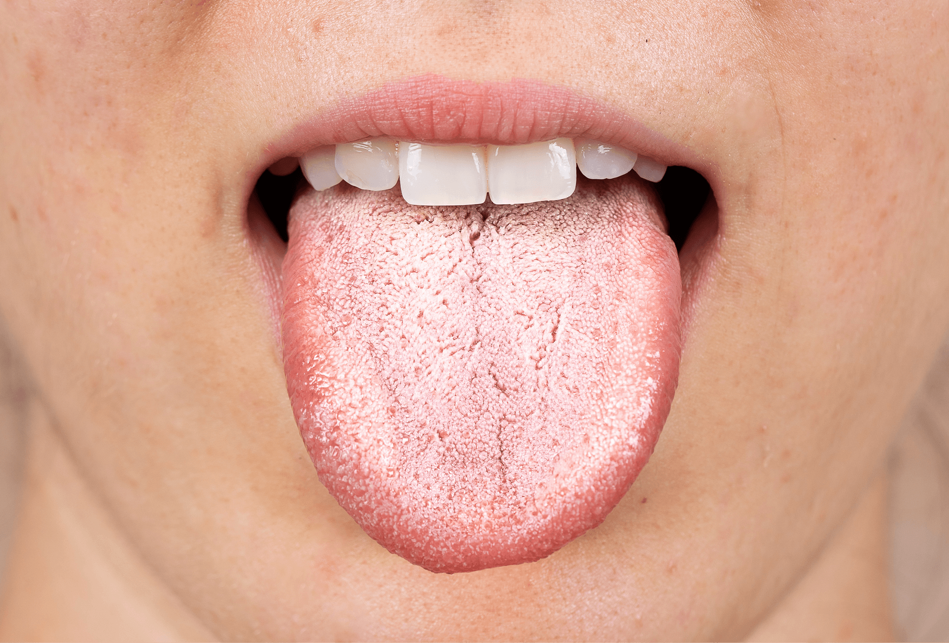 mouth showing oral thrush on tongue