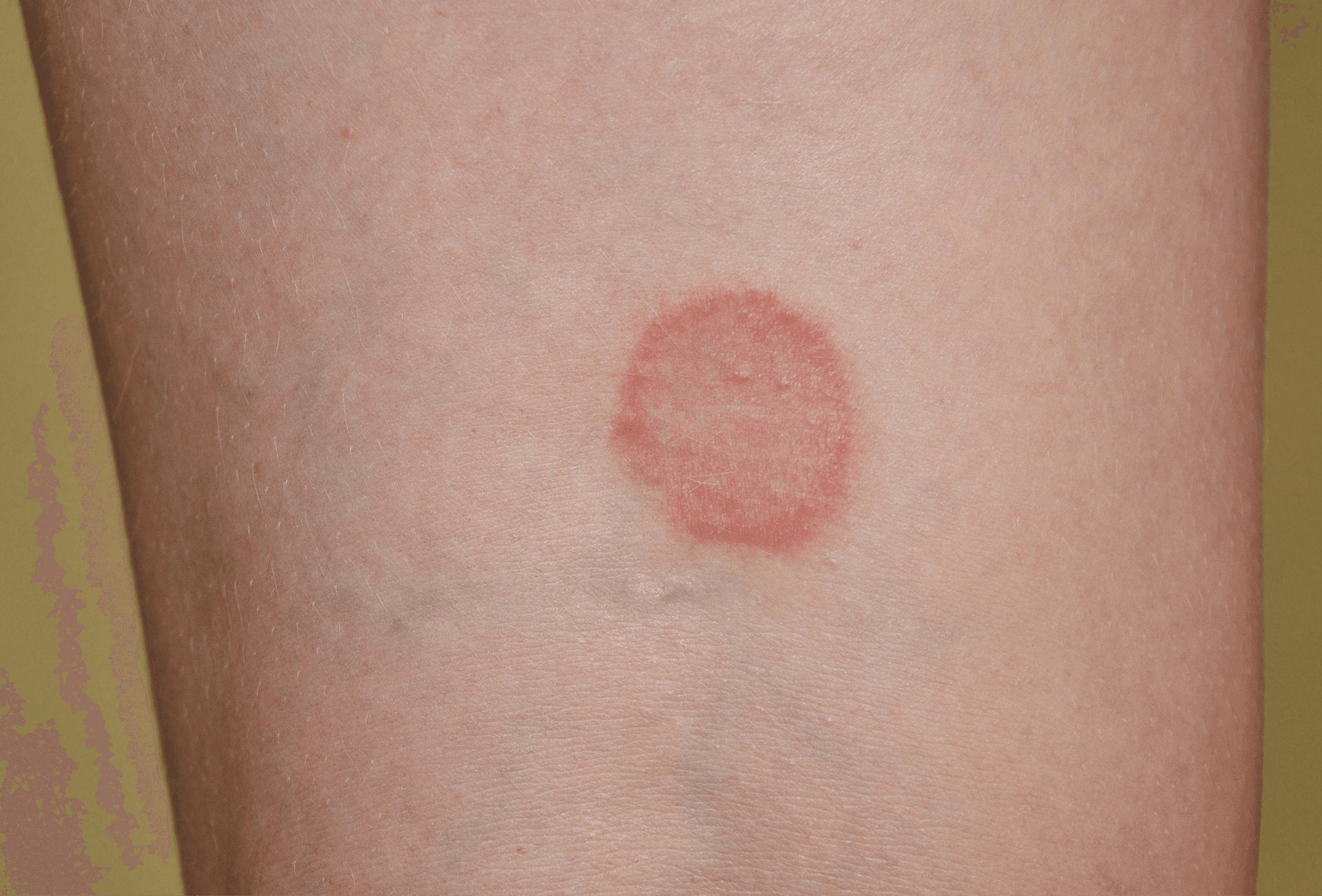 circular rash showing on skin